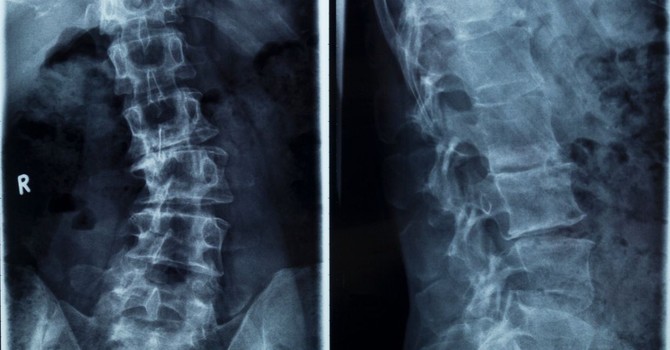 Can I Fix My Scoliosis Naturally?  image