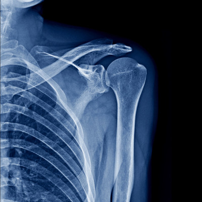 Digital xray for shoulder injury after car accident chiropractor tampa 2026 