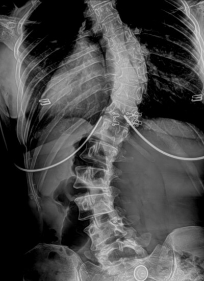 xray of a scoliosis