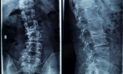 image of a spinal xray to identify origins of sciatica 