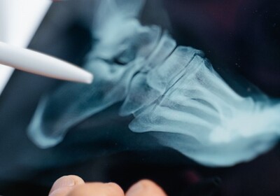 ankle xray performed after a car accident