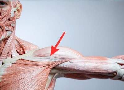 digital image of the anatomy of a rotatorcuff injury 